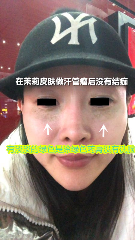 深圳茉莉皮肤治疗汗管瘤不会结痂